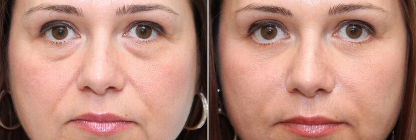 Before and after blepharoplasty - removal of fat under the eyes and skin tightening